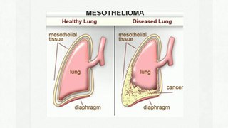 Shrader & Associates, LLP is a Professional Mesothelioma Law Firm