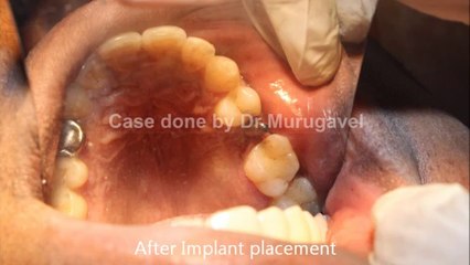 DENTAL IMPLANTS IN INDIA - PERMANENT TEETH IN 1 DAY