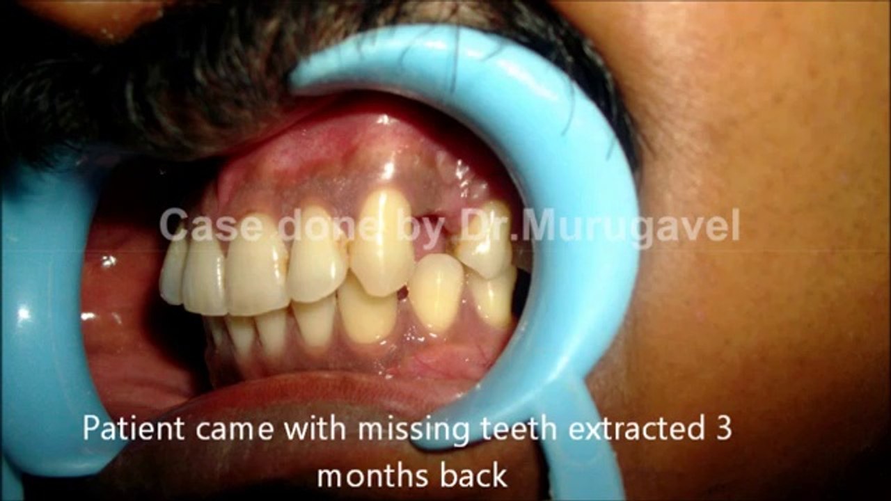 DENTAL IMPLANTS IN INDIA[1]