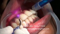 Depigmentation of Gingiva using Zolar Diode Laser video Part 1
