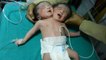 Naissance d'un bébé à 2 têtes en Inde
