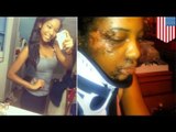 Aspiring model brutally beaten documents recovery on Instagram