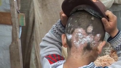 An infected victim of Syria's three-year civil war