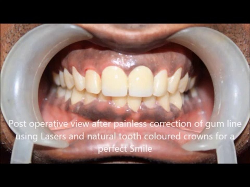 Regaining a perfect smile