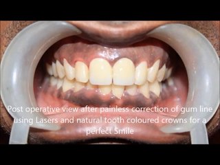 Regaining a perfect smile