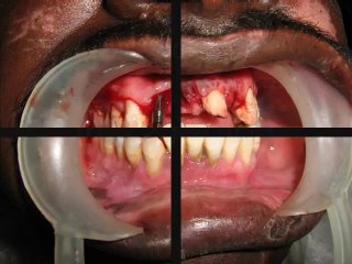 New Teeth fixed immediately after tooth loss due to accident