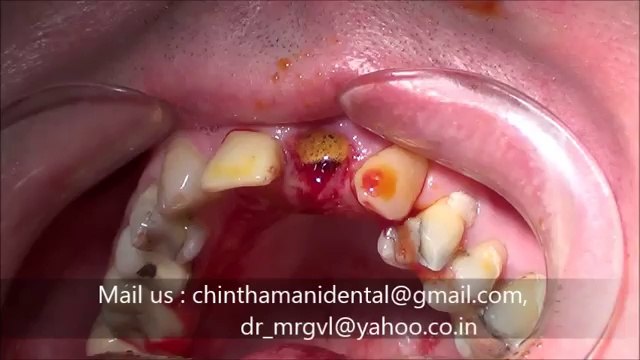 Accident front tooth fracture- extraction & immediate implant video 2