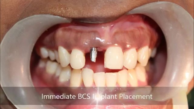 Severe gum abscess tooth extraction and immediate BCS implant placement!