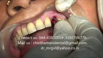 Upper canine rootstump extraction and BCS dental implant in India video part 2