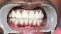 ZIRCONIUM CROWNS FOR FRONT TEETH