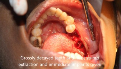 PREFECT IMPLANT VIDEO