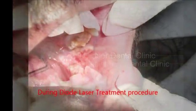 Laser Treatment for a Patient with Oral Sub-mucous Fibrosis