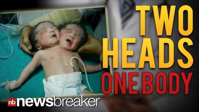 TWO HEADS: Rare Conjoined Twins Born in India Share One Body