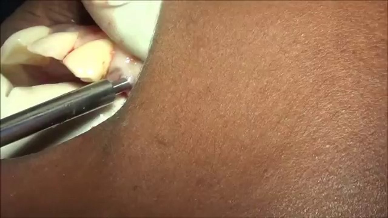 Flapless BCS Implant procedure video