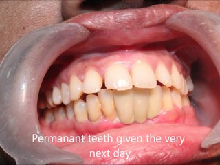 Single piece implant BCS