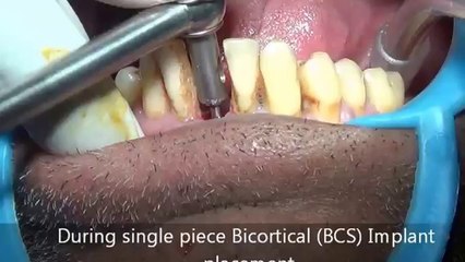 HAPPY PATIENT AFTER DENTAL IMPLANT PLACEMENT[1]