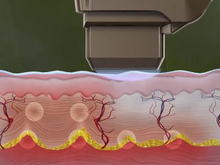 Ultraformer ile Ameliyatsız Yüz Germe - Nsc Klinik