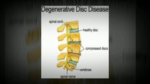 Get Help for Degenerative Disc Disease at Gulf Coast Spine Care