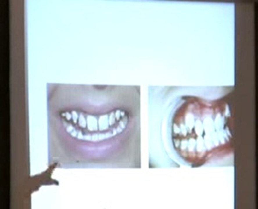Dr. James Beck Fluoride Discussion