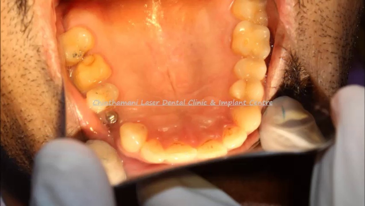 AFFORDABLE DENTAL IMPLANTS IN CHENNAI (2)