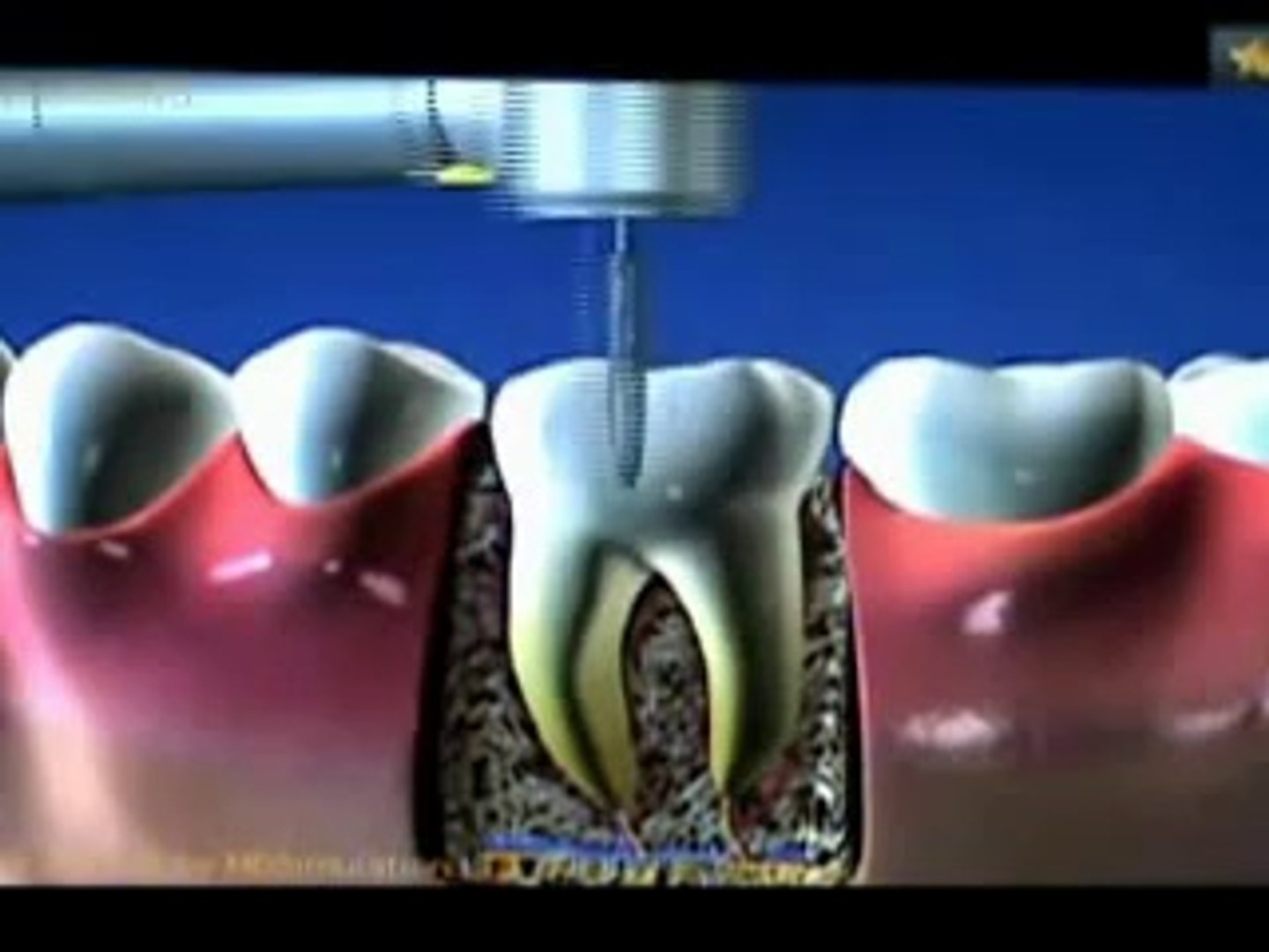 Devitalisation Dentaire Reconstitution Par Pivot Et Couronne Video Dailymotion