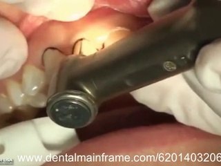 Preparation Six Maxillary Anterior Veneers by Dr. Ed McLaren
