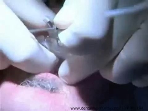 SINGLE VISIT IMPLANTS USING All On 4 Dental Implants SYSTEM,Guided Surgery