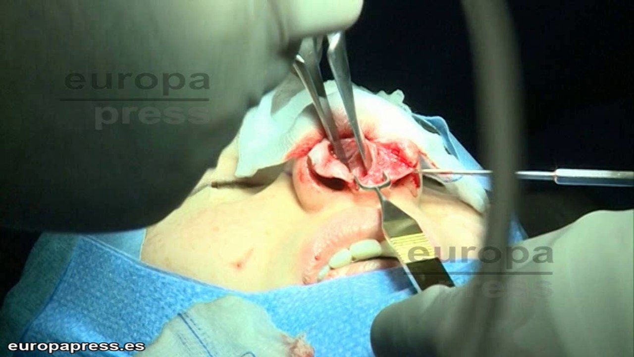 Tecnología aeroespacial para la cirugía de nariz