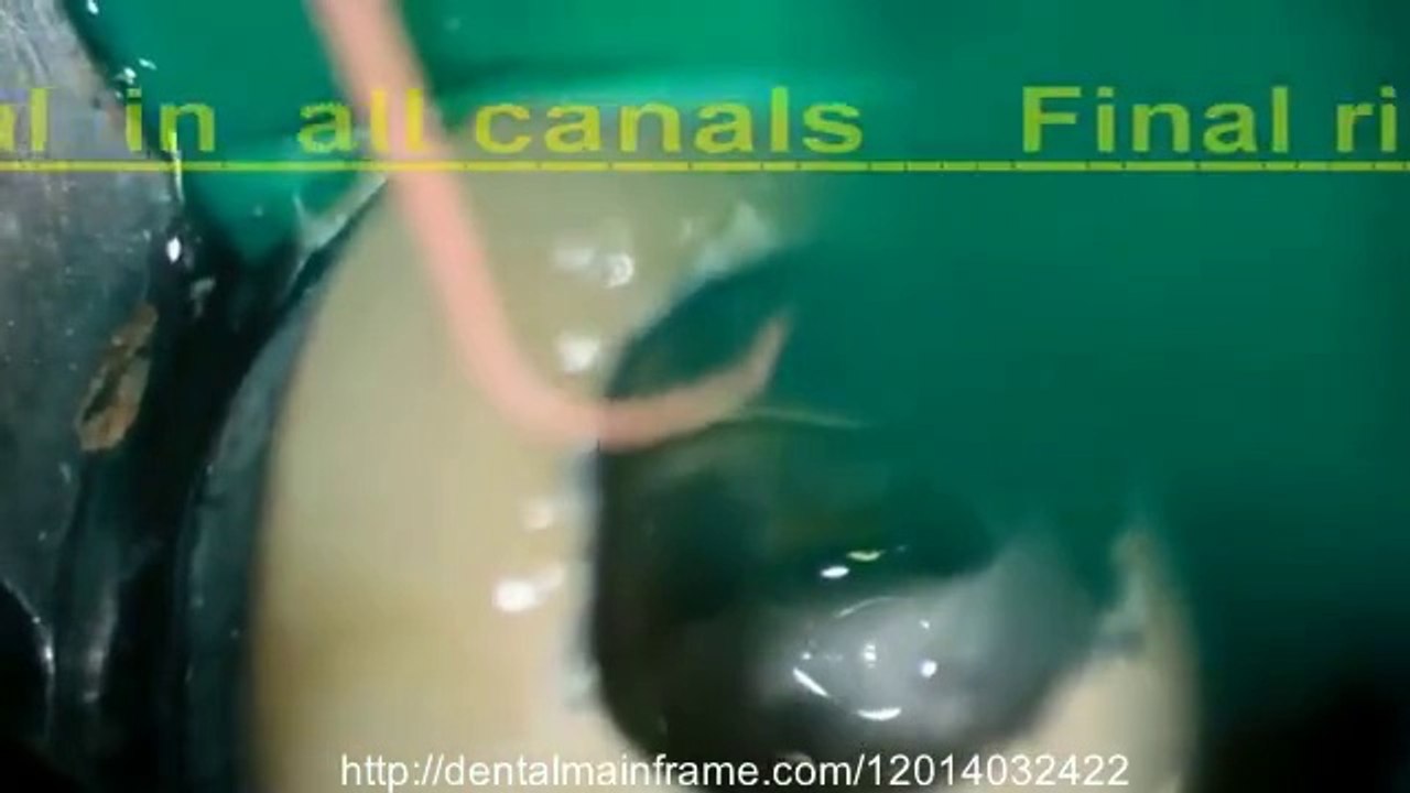 Root canal treatments in extreme root canal anatomy