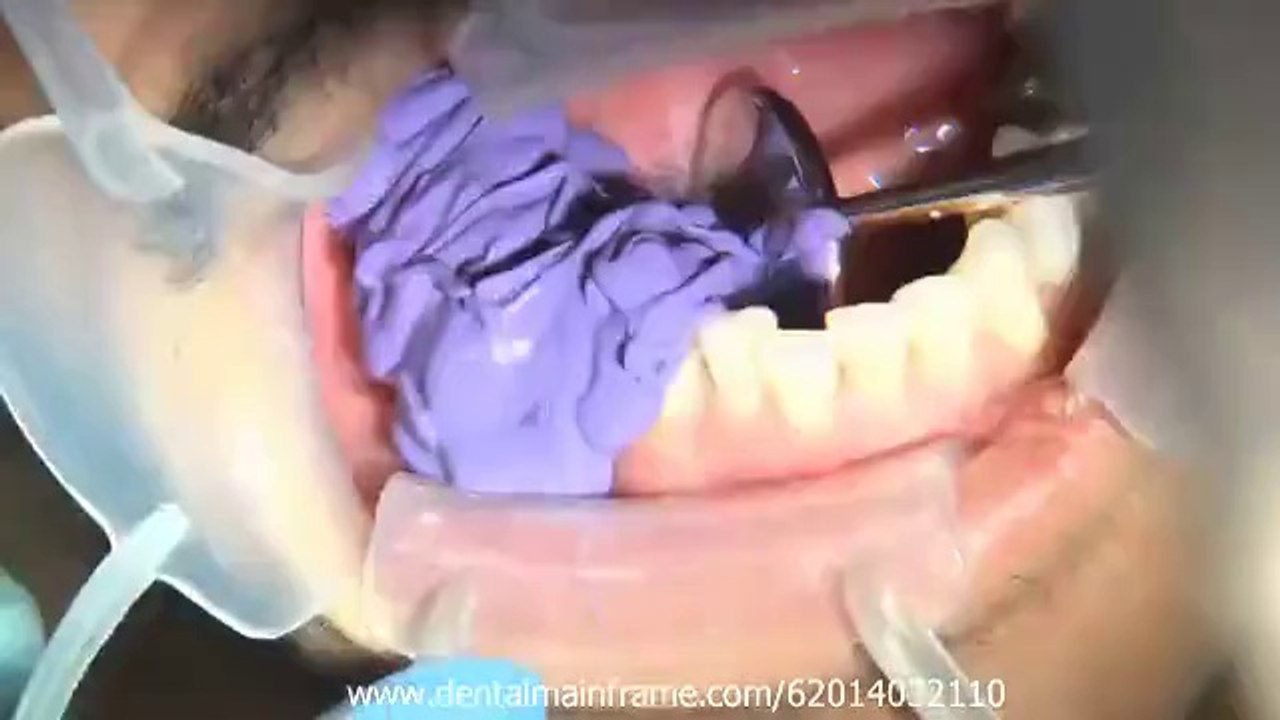 Bruxzir® Solid Zirconia-Indications & Clinical Techniques, Ch.2_(new)