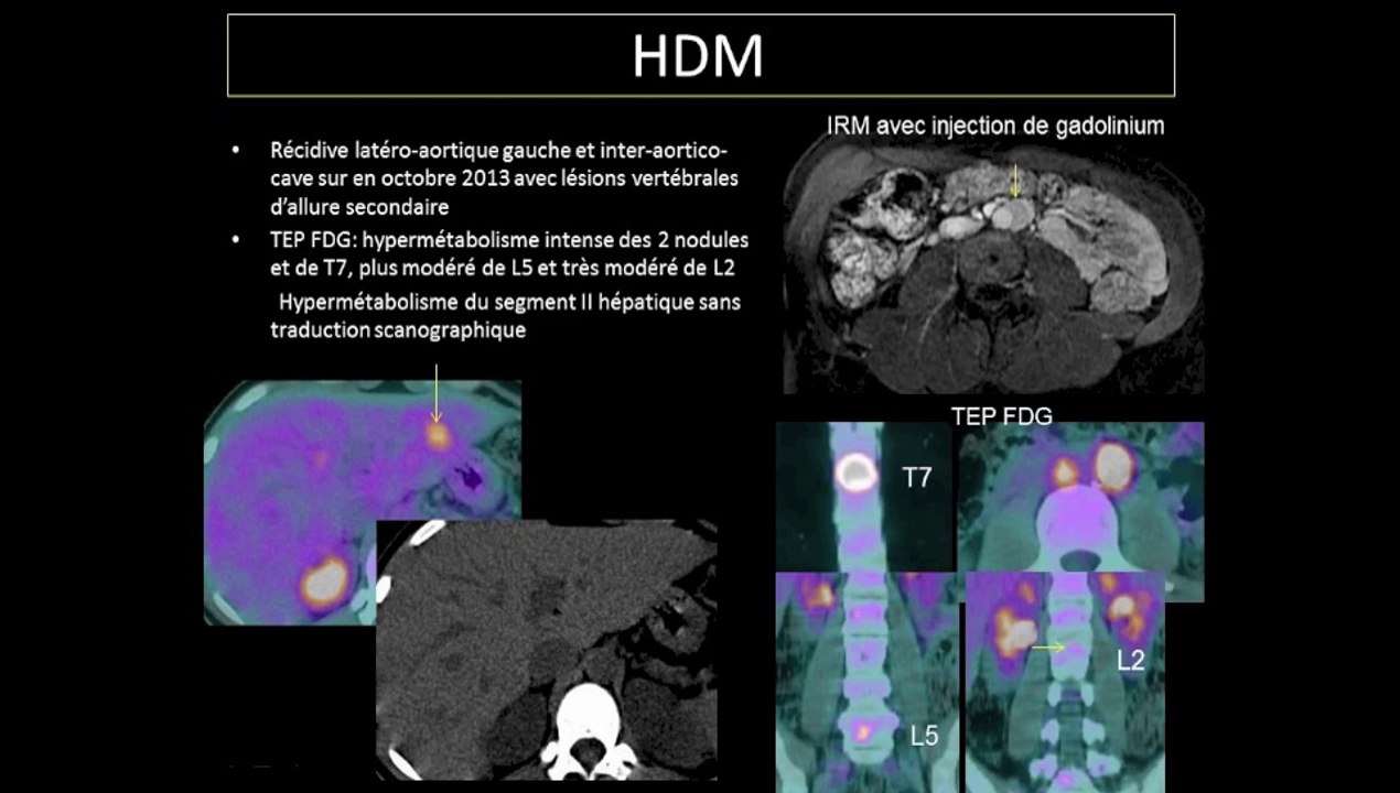 Des métastases quasi pathognomoniques