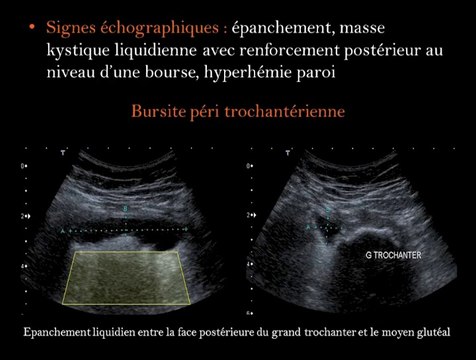 Images clés des bursites de la hanche