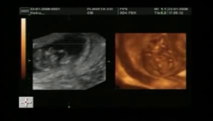 Если у вас начался токсикоз