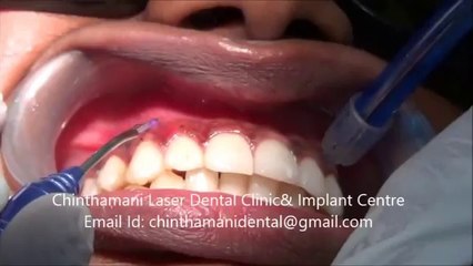 Depigmentation of Gingiva using Zolar Diode Laser video Part 2