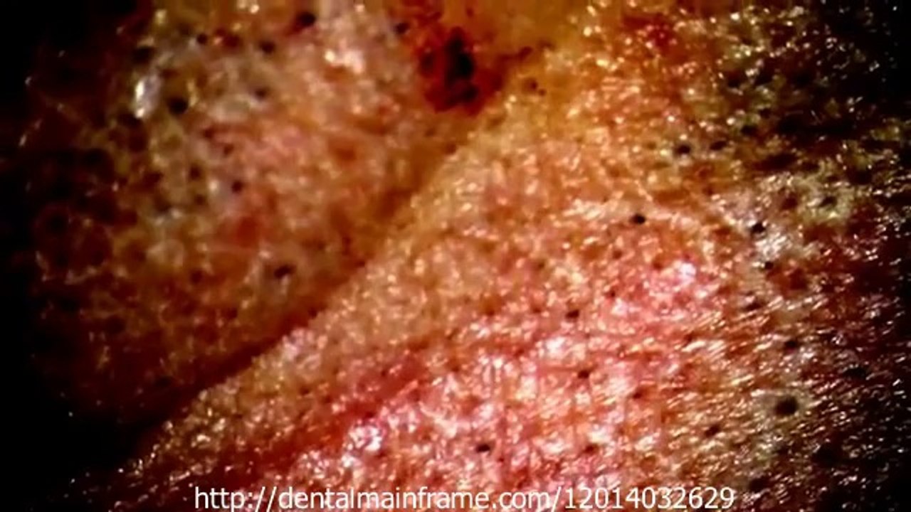 PERI-IMPLANTITIS OPEN FLAP SURGERY WITH ERYAG LASER, STRAUMANN TL IMPLANT