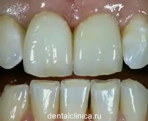 Лечение зубов красивая улыбка коронка циркониевая металлокерамика приятные цены протезирование имплант СГС с абатмантом экспересс терапия