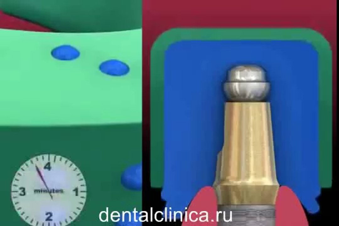 Лечение зубов красивая улыбка коронка циркониевая металлокерамика приятные цены протезирование имплант СГС с абатмантом экспересс терапия