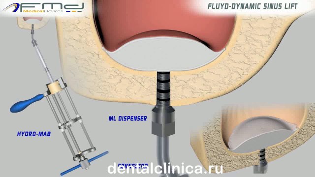 Лечение зубов красивая улыбка коронка циркониевая металлокерамика приятные цены протезирование имплант СГС с абатмантом экспересс терапия