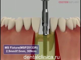 Лечение зубов красивая улыбка коронка циркониевая металлокерамика приятные цены протезирование имплант СГС с абатмантом экспересс терапия