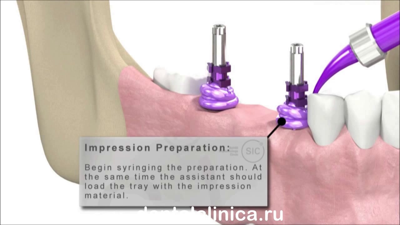 European Clinic of Aesthetic Dentistry Лечение зубов красивая улыбка коронка циркониевая металлокерамика приятные цены протезирование имплант СГС с абатмантом экспересс терапия