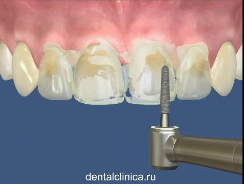 European Clinic of Aesthetic Dentistry Лечение зубов красивая улыбка коронки циркониевые металлокерамика приятные цены протезирование имплант СГС с абатмантом экспересс терапия