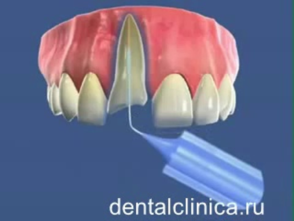European Clinic of Aesthetic Dentistry Лечение зубов красивая улыбка коронки циркониевые металлокерамика приятные цены протезирование имплант СГС с абатмантом экспересс терапия