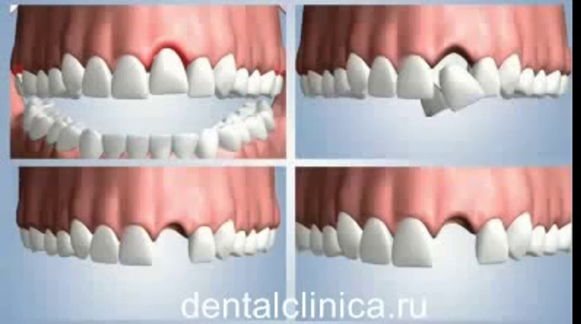 ⁣European Clinic of Aesthetic Dentistry Лечение зубов красивая улыбка коронки циркониевые металлокера