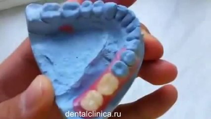 European Clinic of Aesthetic Dentistry Лечение зубов красивая улыбка коронки циркониевые металлокерамика приятные цены протезирование имплант СГС с абатмантом экспересс терапия