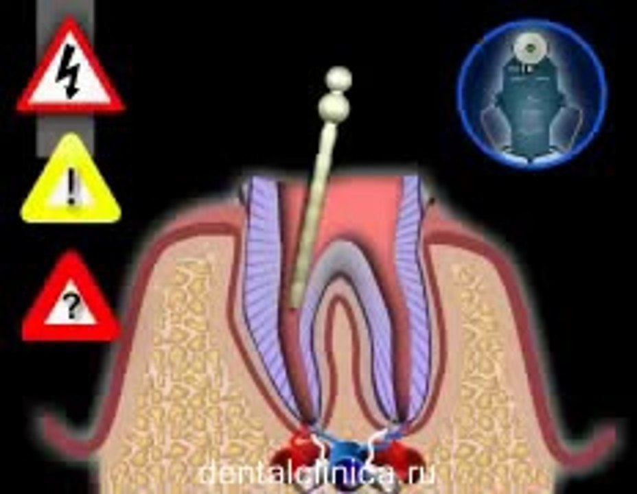 European Clinic of Aesthetic Dentistry Лечение зубов красивая улыбка коронки циркониевые металлокерамика приятные цены протезирование имплант СГС с абатмантом экспересс терапия