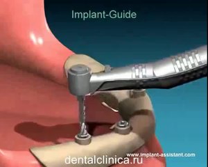 European Clinic of Aesthetic Dentistry Лечение зубов красивая улыбка коронки циркониевые металлокерамика приятные цены протезирование имплант СГС с абатмантом экспересс терапия