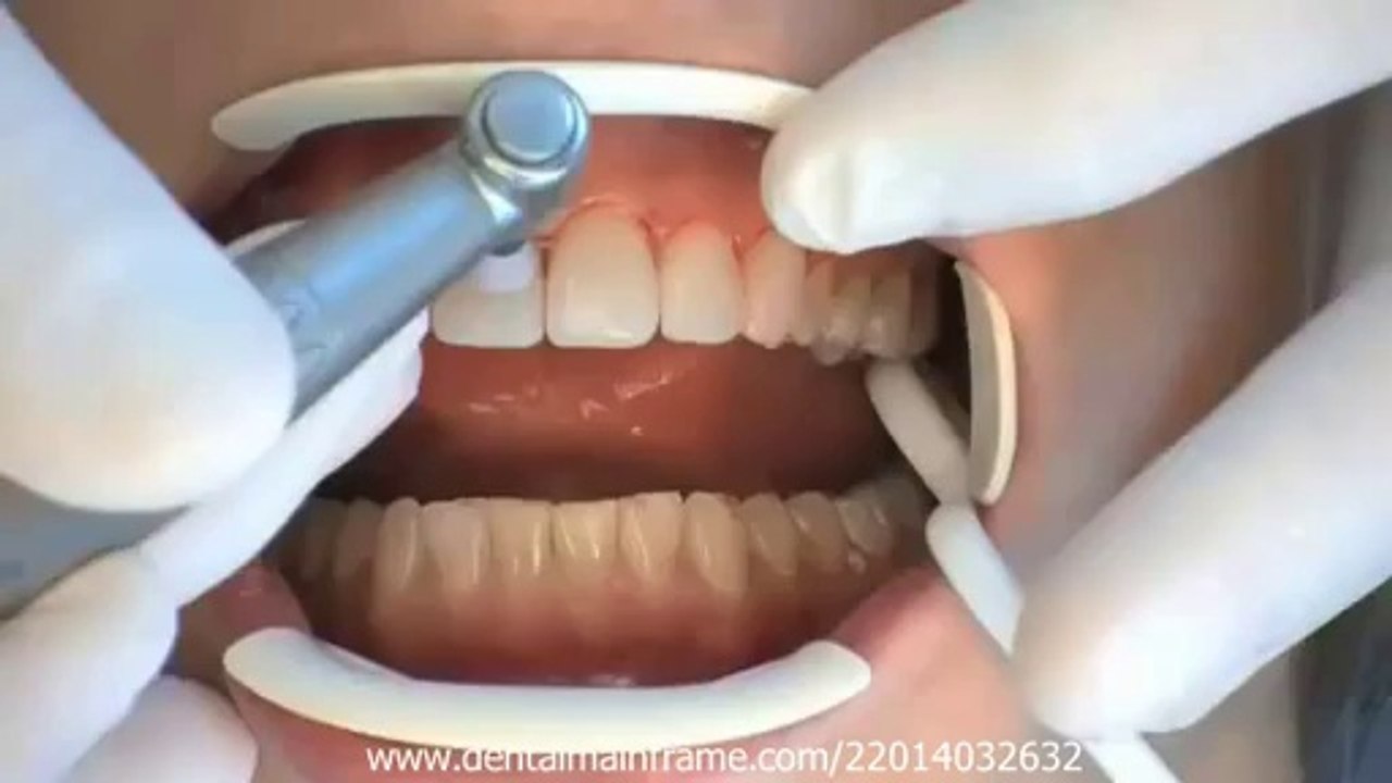 COMPONEER DIRECT COMPOSITE VENEERING SYSTEM