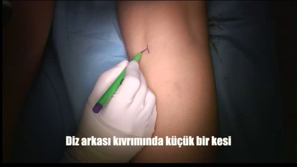Çarpık Parantez  Bacak Estetiği : Ahmet Karacalar, Prof. Dr.