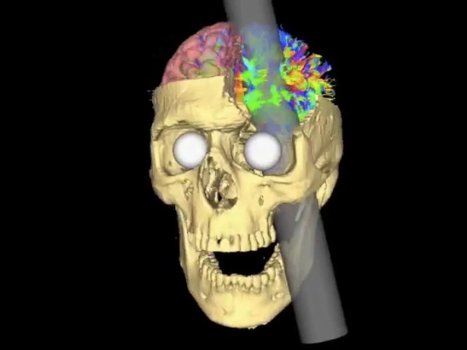 Phineas Gage: Cerebro 3D