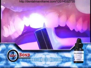 Direct Composite Veneers by Dr. Jeff T. Blank